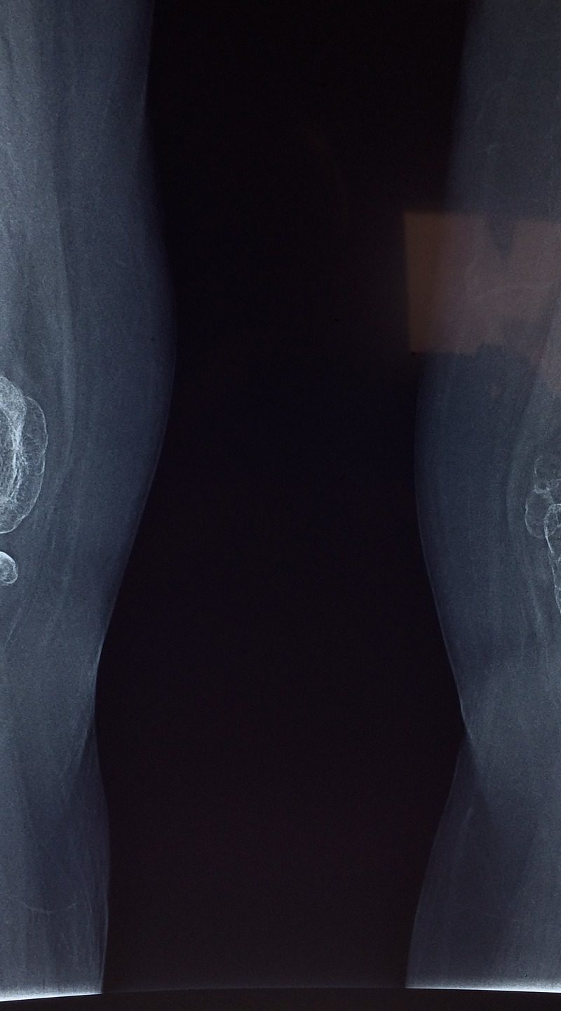 Artroskopia kolana – najlepsza diagnoza.